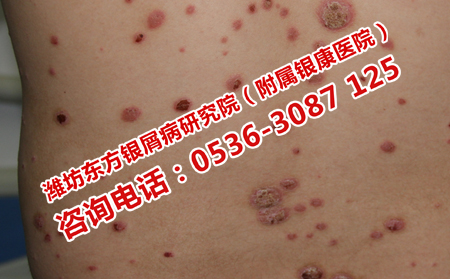 牛皮癣怎么治可以