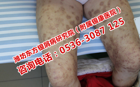 牛皮癣皮肤炎症怎么保健