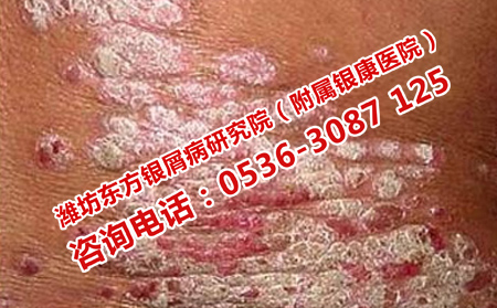 一次性可以治可以牛皮癣吗