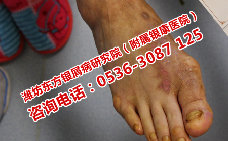 牛皮癣在治疗上的误区