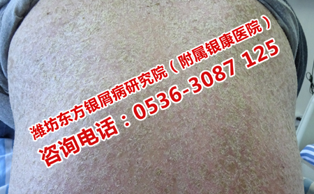 山东银屑病医院排名