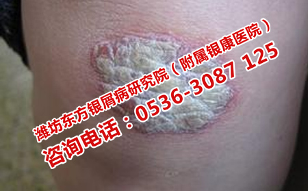 治疗牛皮癣快速的西医方法