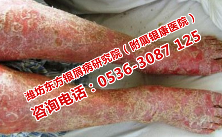 西医治银屑病的优势