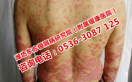 银屑病治疗要科学