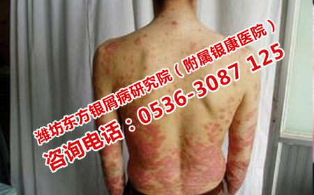银屑病可以转的临床症状