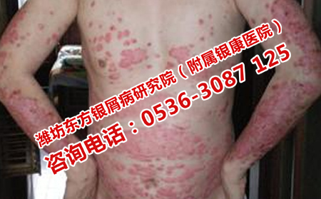 不当治疗对银屑病的伤害