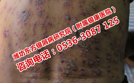 济南银屑病医院治疗费用
