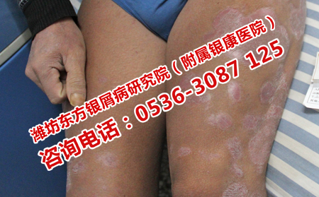 后天发生银屑病会遗传吗