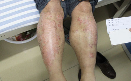 济南银屑病医院治疗