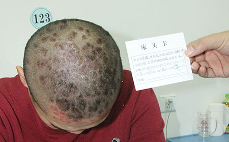 银屑病和其他皮肤病的区分