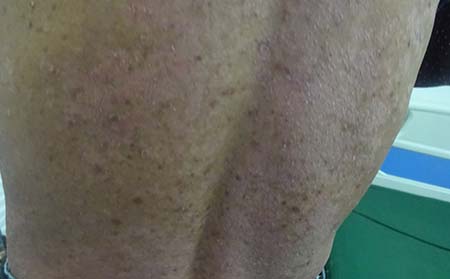 银屑病保健措施