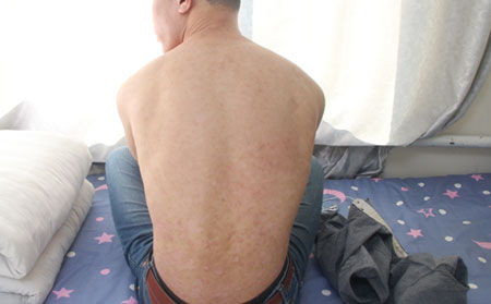 治疗银屑病中成药