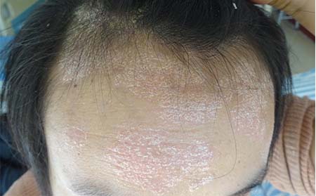 银屑病治疗介绍