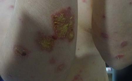 银屑病传染,济南银屑病医院那里好